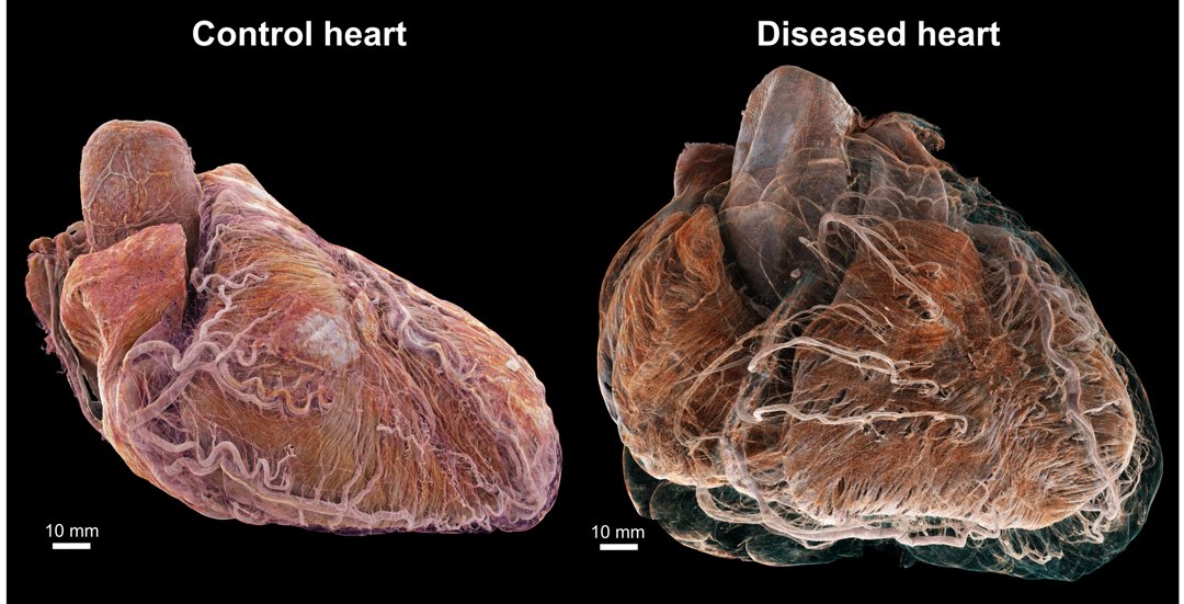 Three-dimensional cinematic renderings of the control and diseased hearts in anatomic orientation