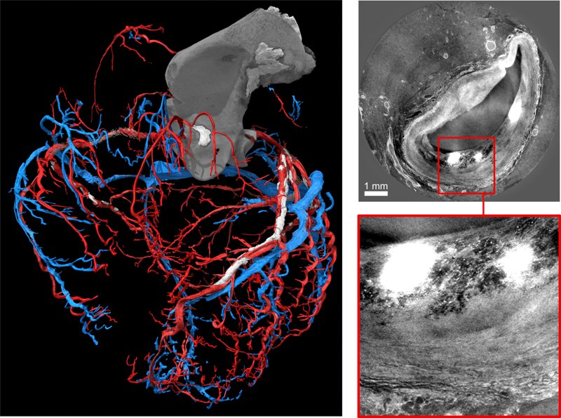 Three-dimensional renderings showing segmentation of the coronary arterial and venous tree in the diseased heart