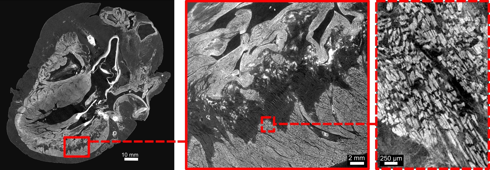 Hierarchical phase-contrast tomography scans of ventricular myocardium in the diseased heart